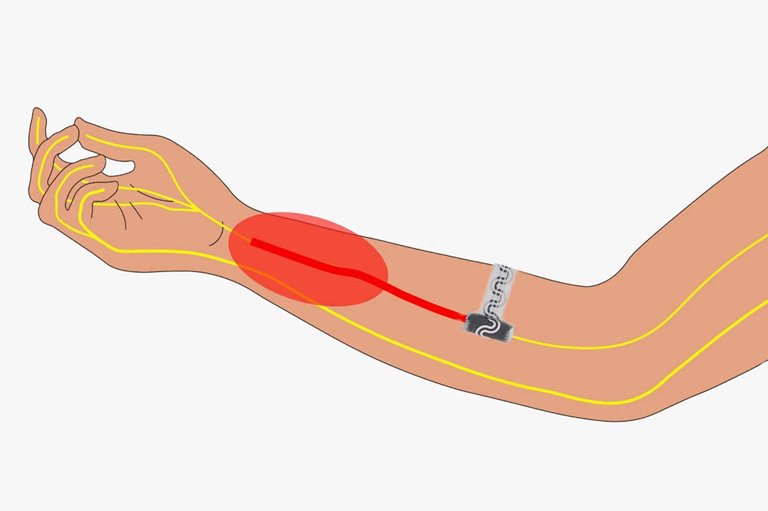 Pain Treatment Without Drugs; This Implant Eliminates Pain By Cooling The Nerve