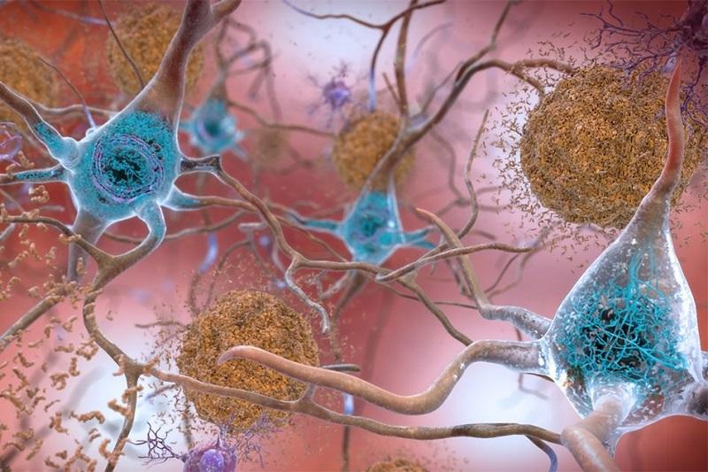The Effect Of Alzheimer's-Related Protein Spots On The Aging Of All Cells