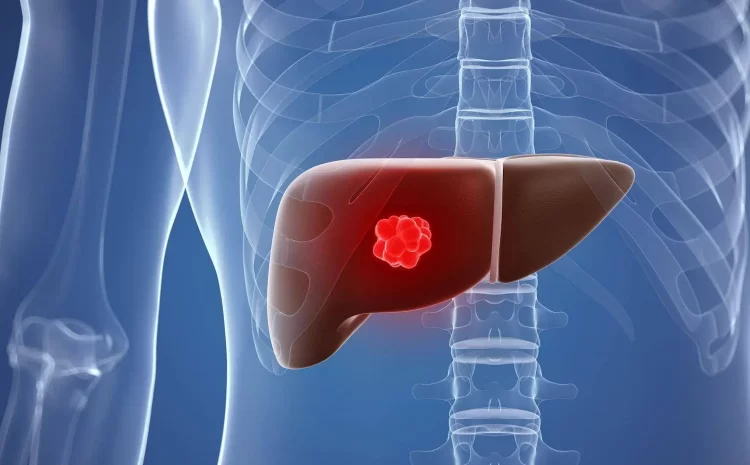 Liver Cancer ; Symptoms, Treatment And Everything You Need To Know