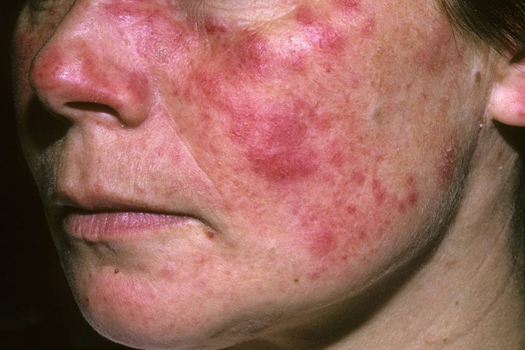 Lupus Disease: Symptoms, Causes, Diagnosis And Treatment